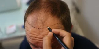 How to get a hair transplant-worthy treatment under expert supervision