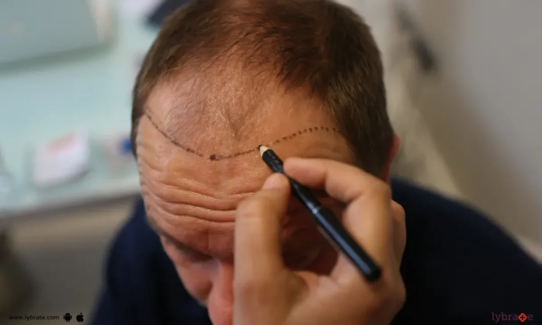 How to get a hair transplant-worthy treatment under expert supervision
