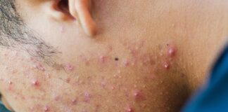 Acne: Causes, Prevention, and Effective Treatments
