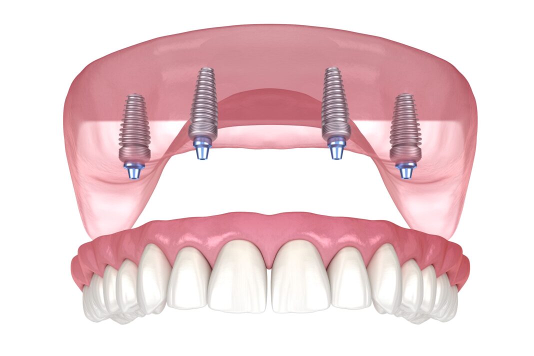 The Advantages of All-on-4 Dental Implants for Patients in Dallas