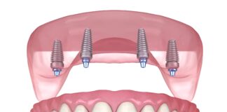 The Advantages of All-on-4 Dental Implants for Patients in Dallas